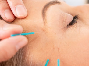 Acupuncture for migraines: how can it help?