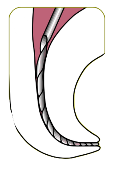 interferenze coronali