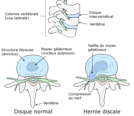 Mécanisme de la hernie discale