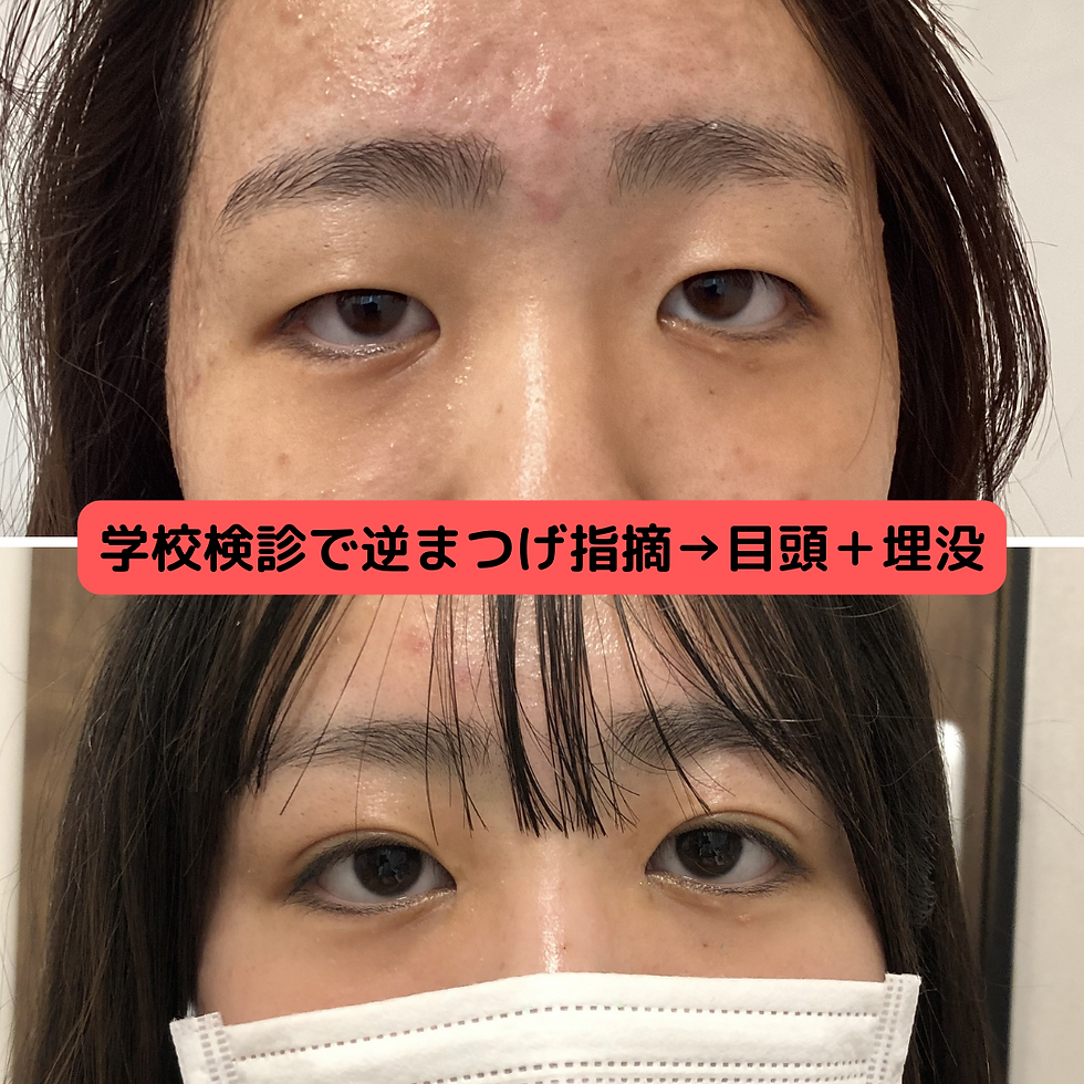 学校検診で逆まつげ指摘→目頭＋埋没手術
