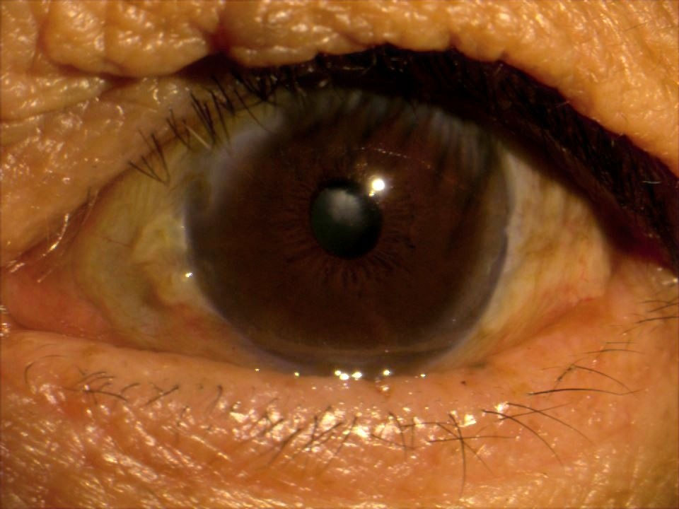 目頭が時々赤くなって痛い 瞼裂斑炎のお話