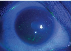 タイゲソン点状表層角膜炎