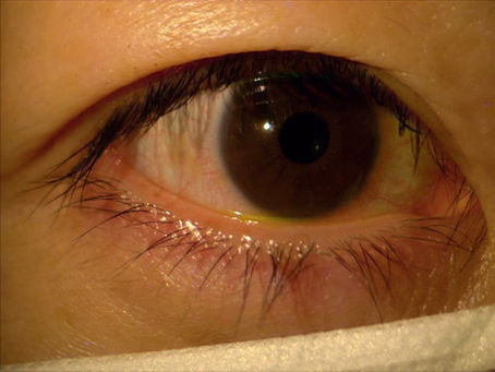 睫毛美容液(ルミガン)の副作用