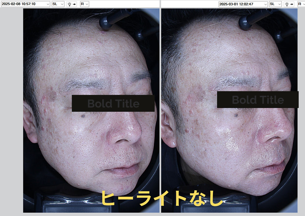 💡 【画像で比較!】イボ除去後の傷跡を早くきれいに治す「ヒーライト」の効果