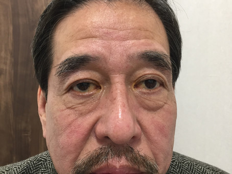眼瞼下垂手術について
