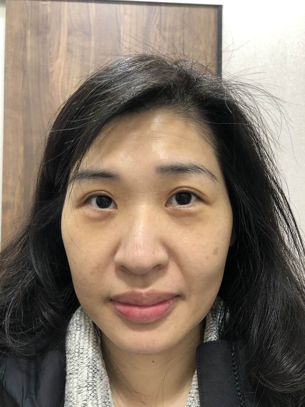 切らないリフトアップ、HIFU(ハイフ）の効果