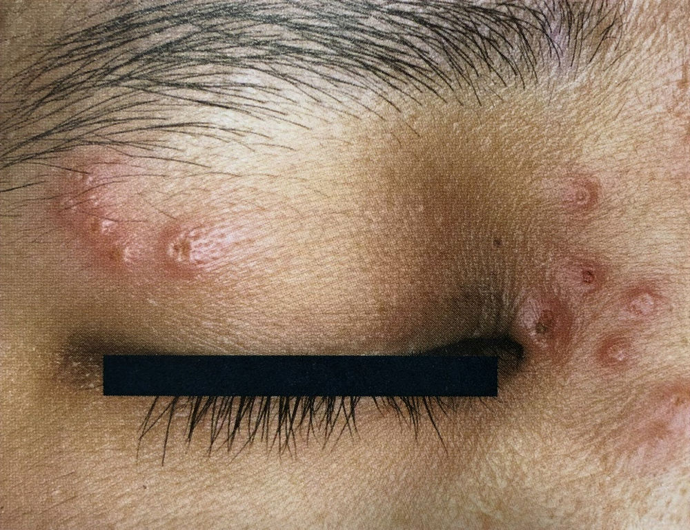 帰って来た目の周りのブツブツシリーズ 眼瞼のヘルペス