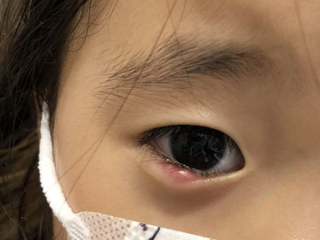 小さいお子様の無麻酔霰粒腫摘出