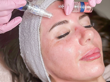 Professional nanoneedling treatment at Mizu in Boulder, Colorado