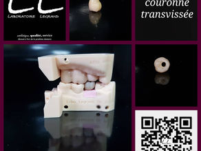 Couronne transvissée céramo-zircone sur t-base
