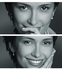 Dentist veneers smile