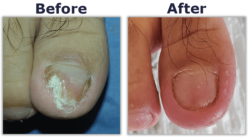 From Pedicures to Pool Floors: How Fungal Infections Spread Undetected