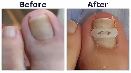Ingrown Toenail Surgery