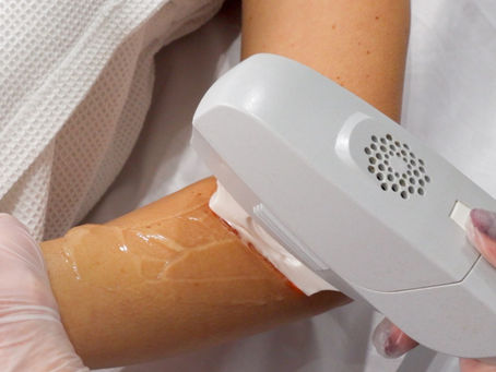 Why Winter is the Best Time to Get Laser Hair Removal Treatments