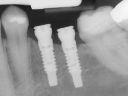 implants-x-ray-pic-2.jpg