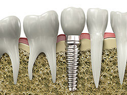 implant-model-pic-1.jpg