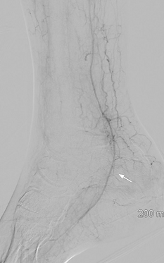 Post-treatment