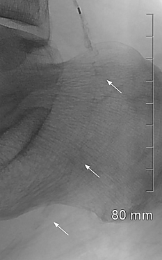 Failed crossing with competitive catheter