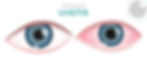 uveitis example