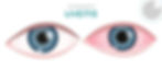 uveitis inforgraphic