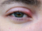 stye