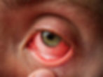 eye with conjunctivitis