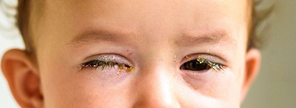 crusty types of eye discharge due to eye infection