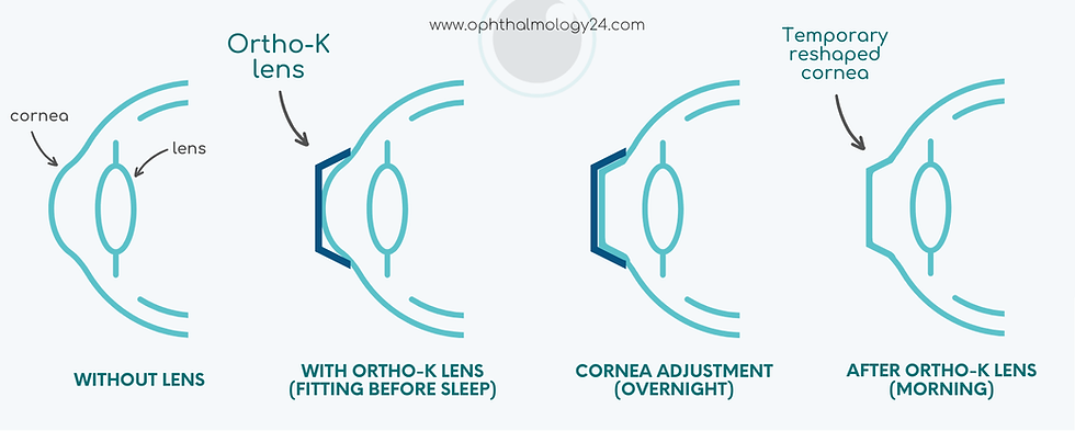Ortho K Lenses Are They Worth It Ortho K Lenses Are They Worth It
