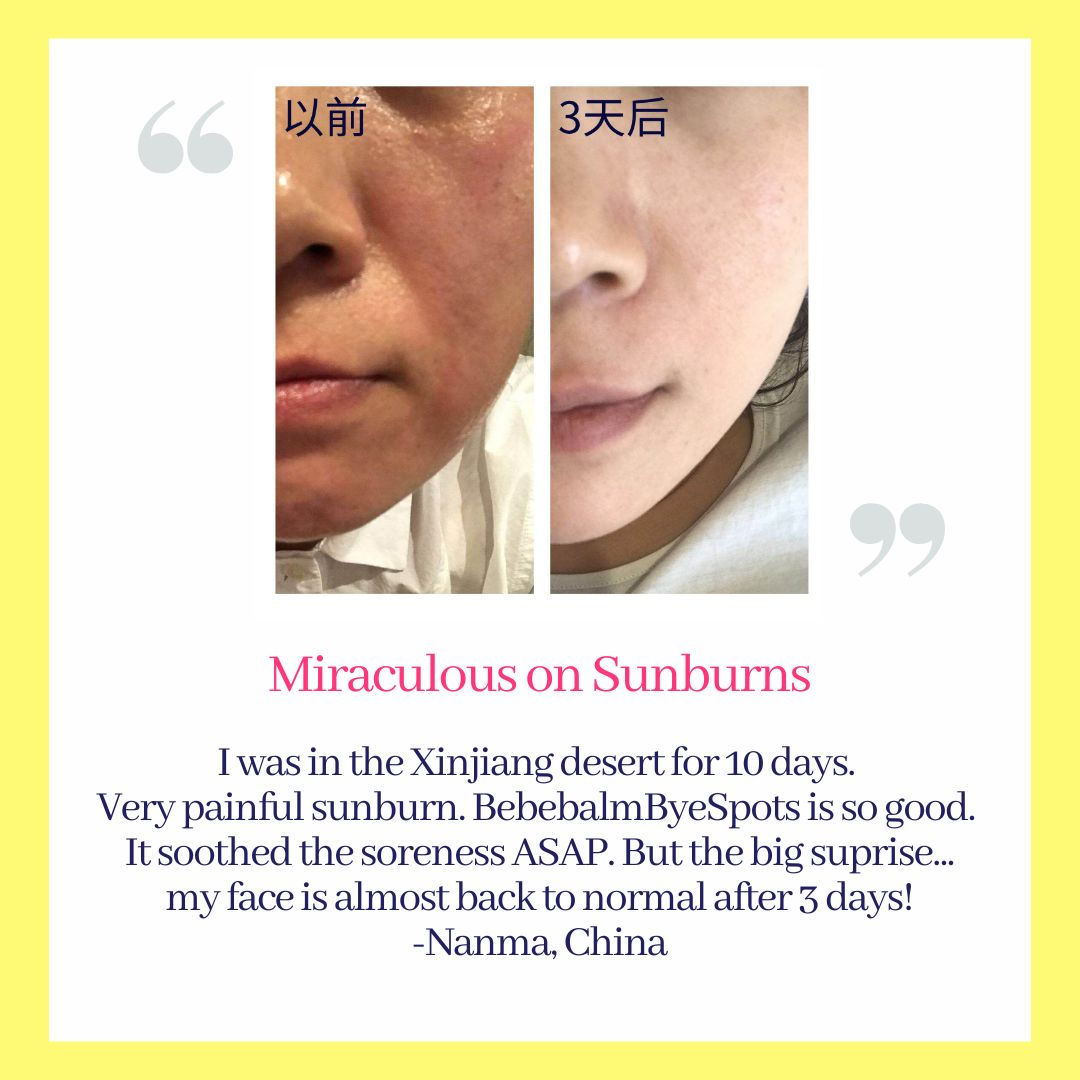 Miraculous on Sunburns.