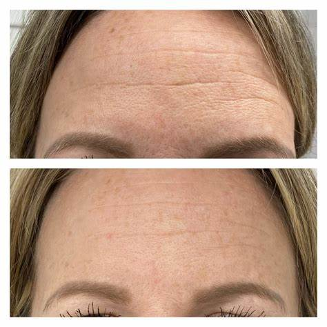 Before and after images of a patient's face treated with microneedling