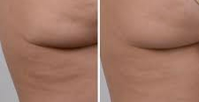 under buttock top of thigh showing cellulite and dimpling before and after microneedling treatments