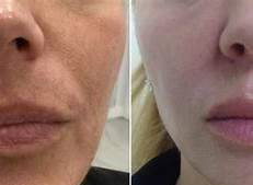 PRP skin before and after