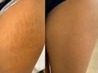 leg showing thigh stretchmarks