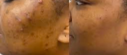 dark skin showing scars and pigmentation before and after microneedling treatment