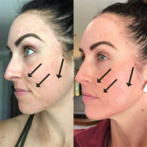 Side-by-side comparison of a person's skin before and after microneedling treatment for acne scars. The after image shows visibly reduced scars and improved skin texture.