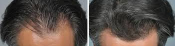 from of man head top of forehead showing before and after treatment prp