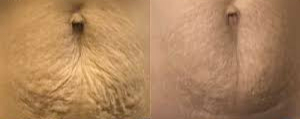 stomach showing wrinkles and stretchmarks before and after microneedling
