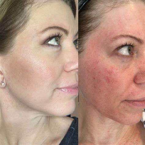 Close-up of a woman's face showing before and after results of microneedling treatment. The after image reveals smoother skin, reduced fine lines, and a more even complexion