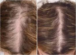hair parting difference before and after treatment hair loss