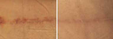 c-section scar before and after microneedling treatment
