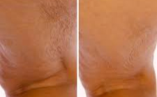 stretchmarks  showing behind knee treated by microneedling before and after