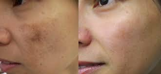 scars and pigmentation on a medium skin face before and after microneedling treatment