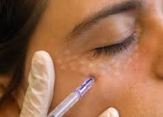white gloved hand injecting into under eye area with 'lumps' at the injection sites as normal