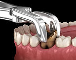 tooth-extraction.jpg