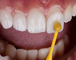 02-veneers.jpg