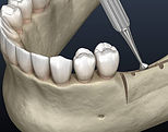 ridge-augmentation.jpg