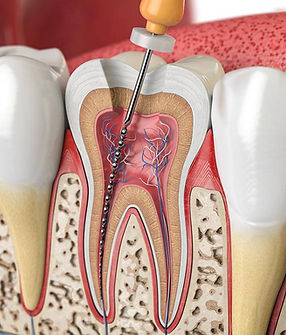 reasons-to-get-root-canal-chalfont-pa.jpg