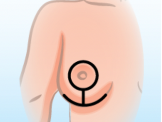 Chapter 55: Breast Reduction Update Part 3