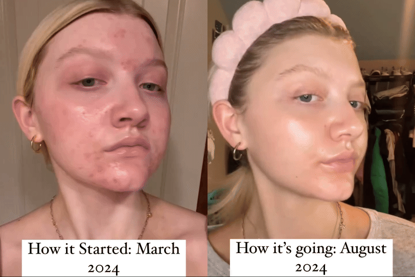 a before and after of a client suffering with acne in March and her very clear skin in August