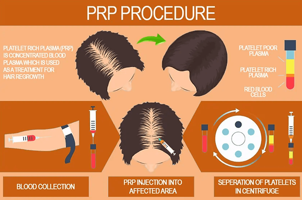 Prp treatment procedure for hair loss